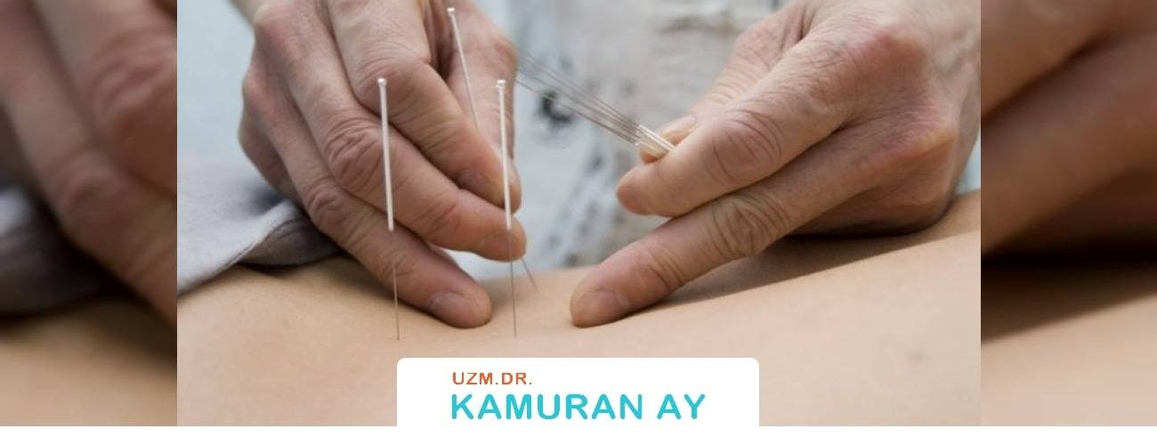 Akupunktur