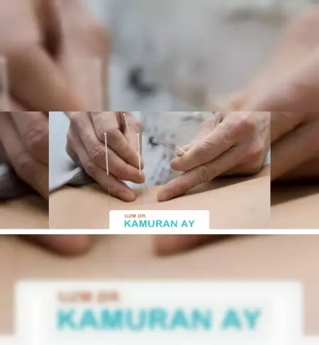 akupunktur