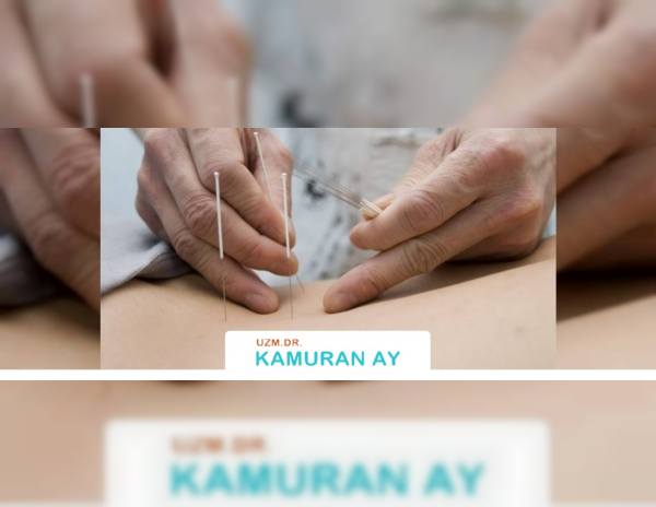 Akupunktur