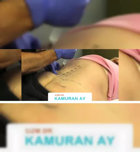 proloterapi